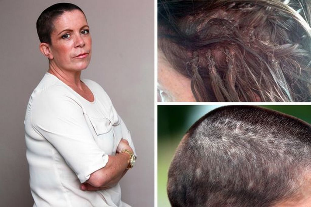 Как выпадают волосы после химиотерапии фото